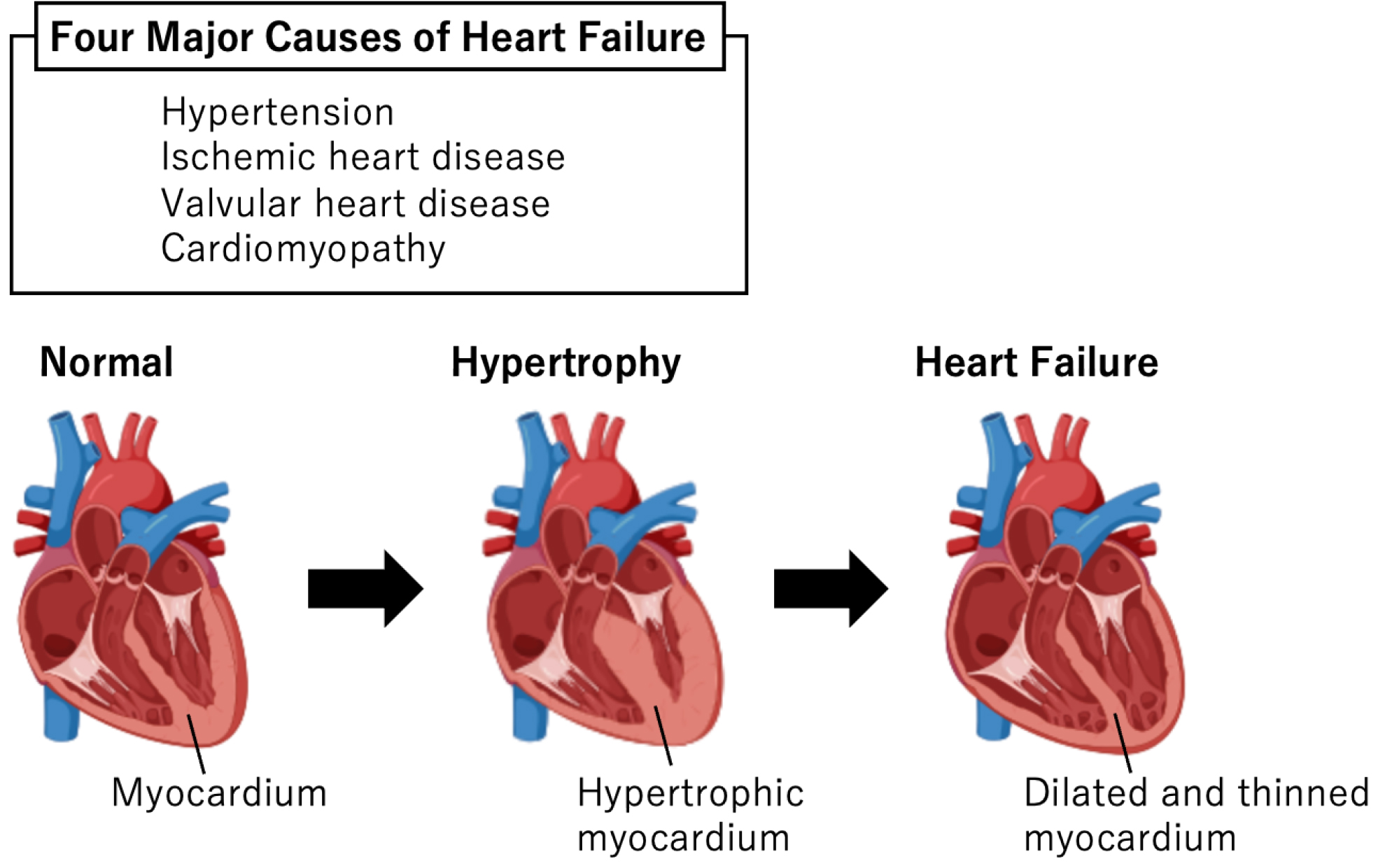 Heart Failure Pathogenesis Elucidation And New Treatment Method
