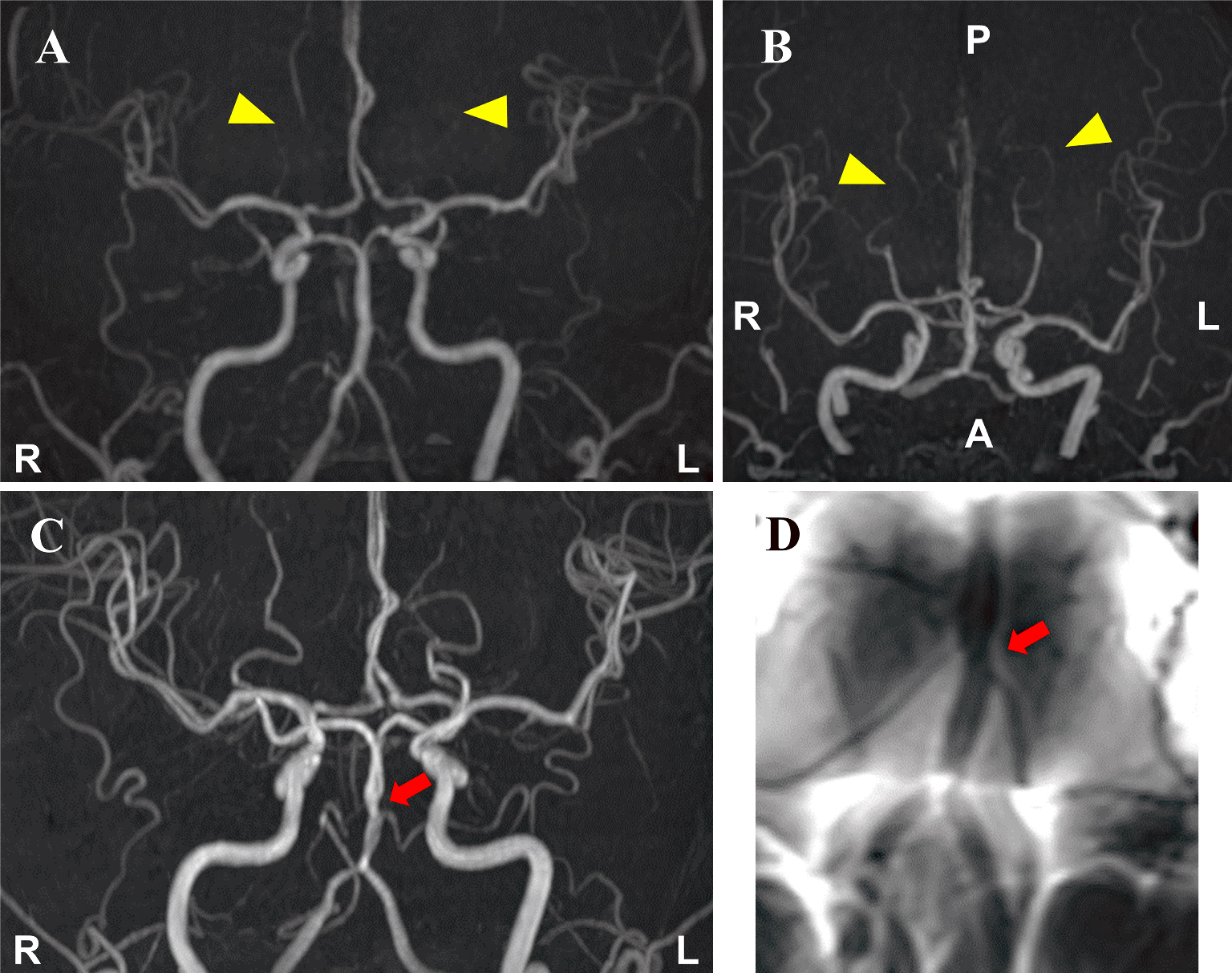 Reversible Cerebral Vasoconstriction Syndrome